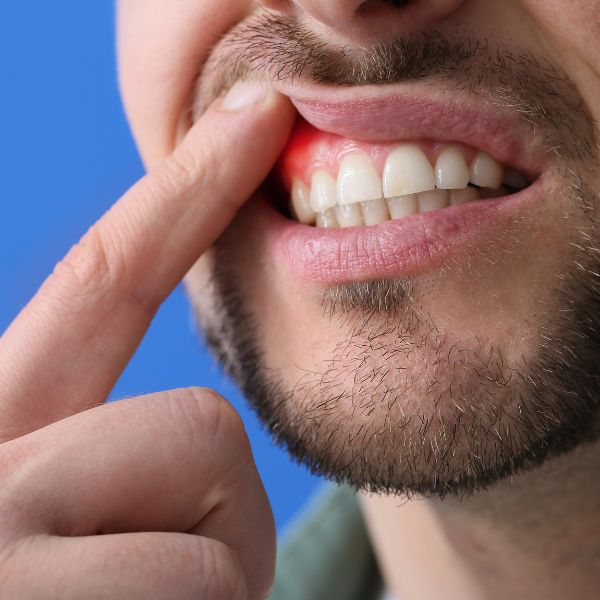 Periodontics or gum disease - centre dentaire Rosemere