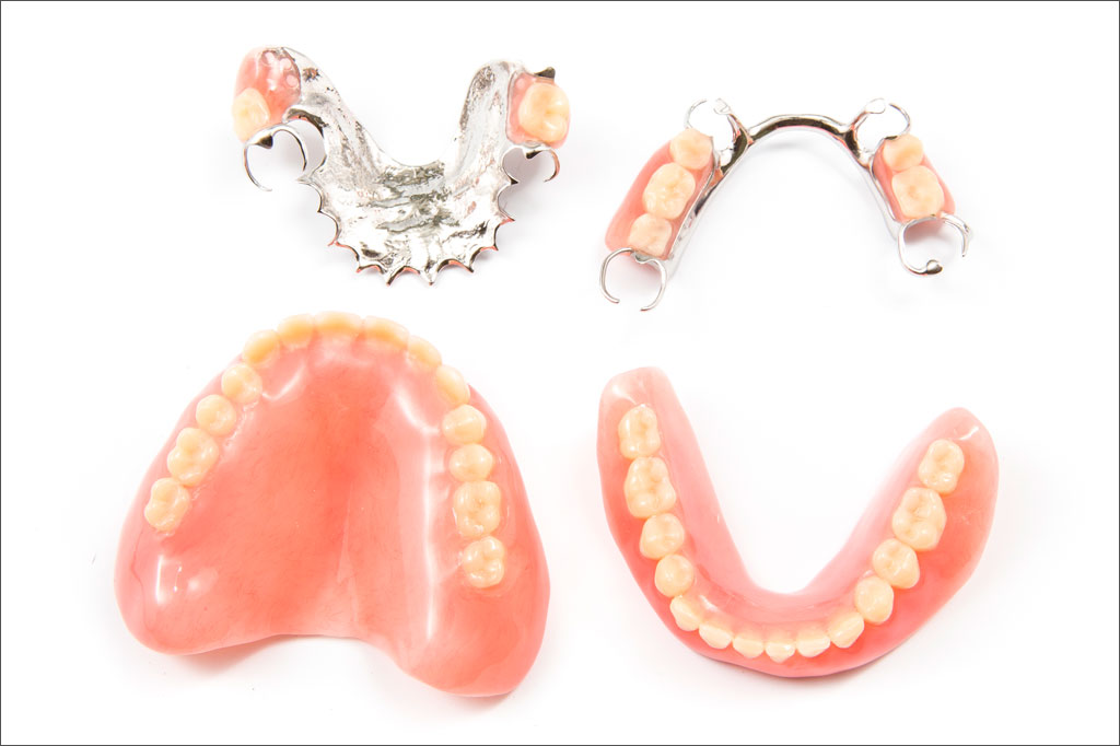 Dentures Over Implants