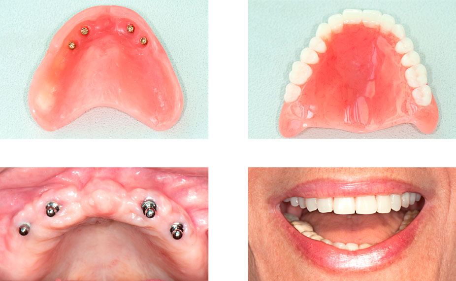 Dentures Over Implants